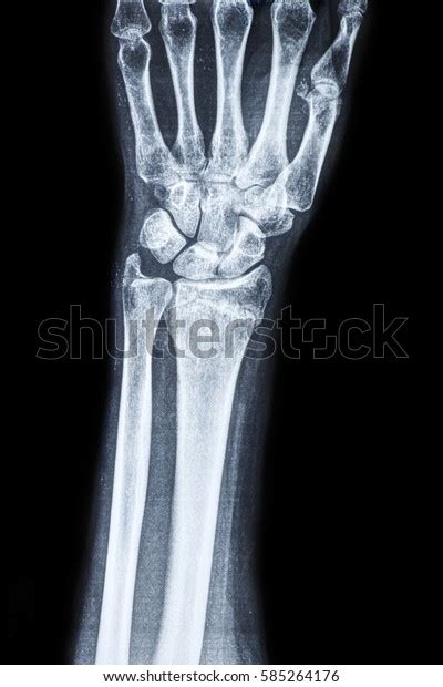 Xray Wrist Human Radius Stock Photo 585264176 Shutterstock