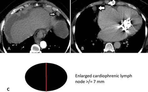Contrast Enhanced Axial Ct Images Showing Examples Of Cardiophrenic