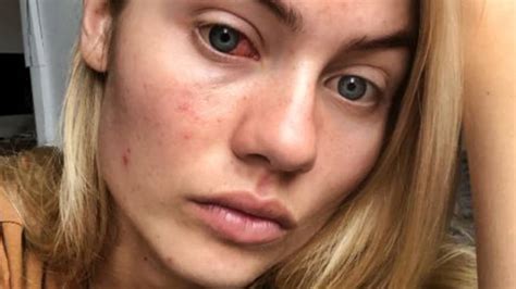 বাংলা চটির hot চুদা চুদির. Elyse Knowles reveals skin battle against pimples, acne ...