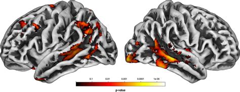 Spatial Maps Of Gray Matter Loss Of Patients With Bd I Relative To