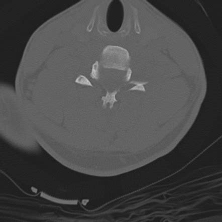 Vertebras Cervicales