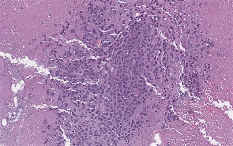 Anaplastic Large Cell Lymphoma Alk Negative With Extensive Necrosis