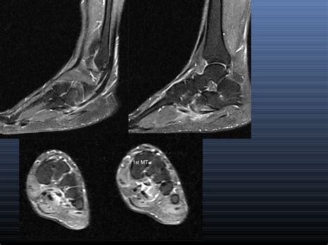 Muscles of the foot muscle origin insertion nerve supply extensor digitorum brevis distal part of the lateral and superior surfaces of the calcaneus and the apex of the inferior extensor retinaculum as the fiber bundles extend distally, they become grouped into four bellies. MRI IN FOOT PAIN