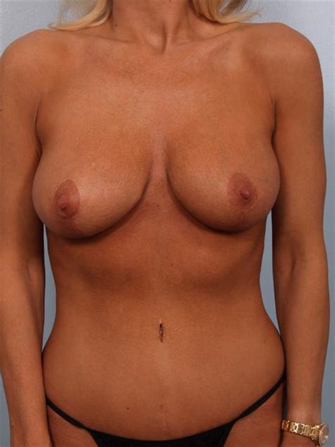 Revision Breast Surgery Before After Photos Patient 36 Paradise