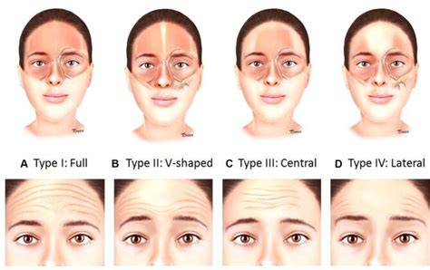 Variation In Frontalis Anatomy And Corresponding Forehead Line