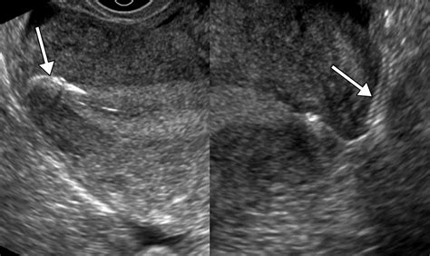 Imaging Evaluation Of Fallopian Tubes And Related Disease A Primer For