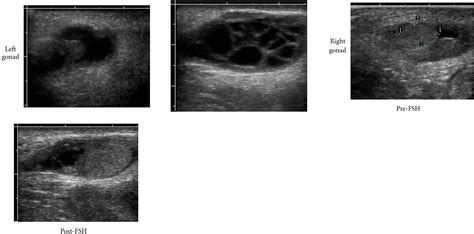 fsh injections and ultrasonography determine presence of ovarian components in the evaluation of