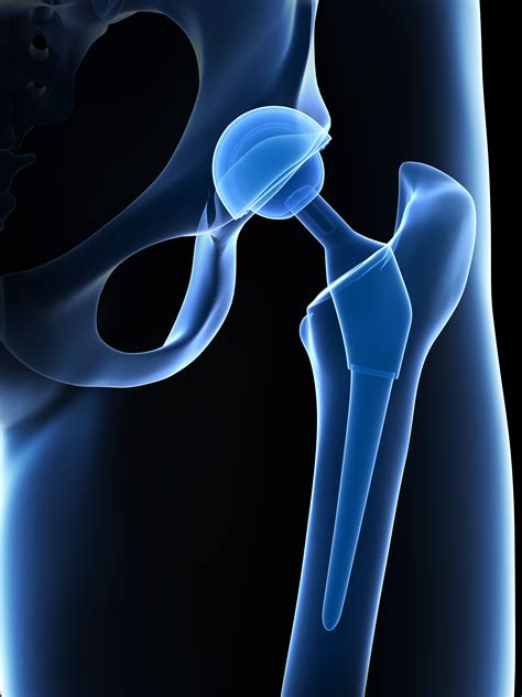 Anterior Approach Hip Replacement Specialist Sorrento Valley San