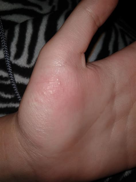 hello i ve had these itchy bumps on my hand for about 3 months now they start itching randomly