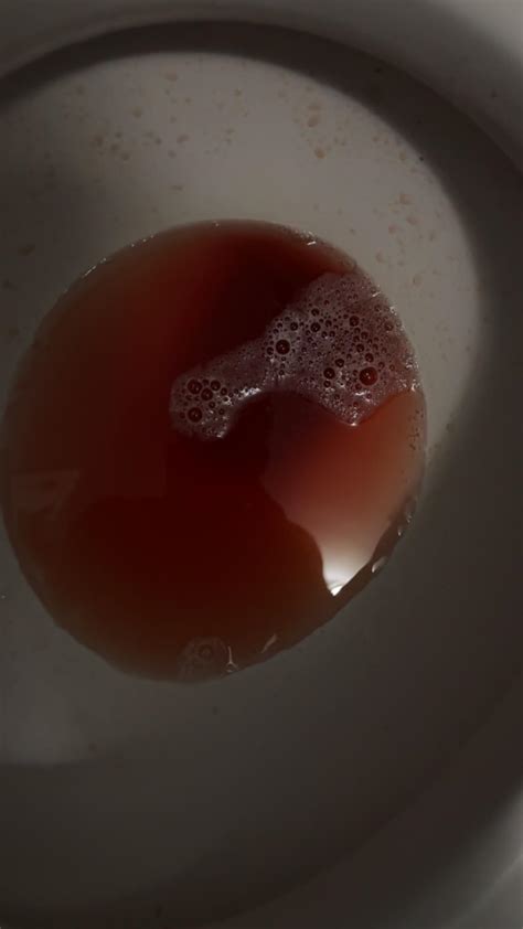 Bloody Urine After Rough Sex Rmedicaladvice