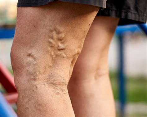 Varicose Veins 5 Signs You Should See A Doctor Vein Center In Walnut Creek Brentwood And