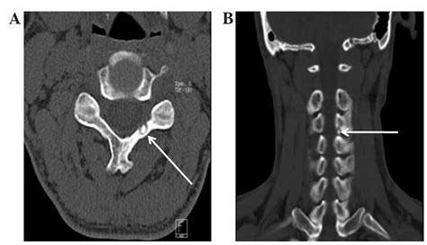 Radionuclide Imaging In The Diagnosis Of Osteoid Osteoma