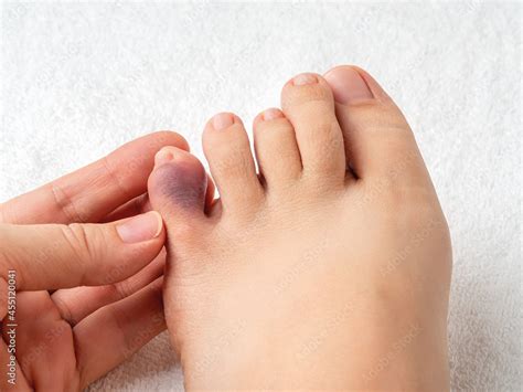 Woman Hand Touching Little Toe With Purple Bruise After Home Accident