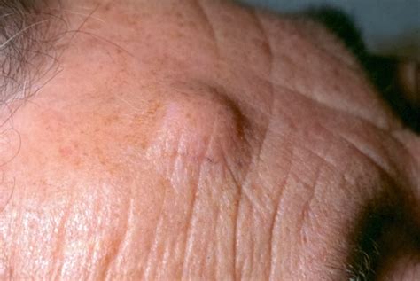 Differential Diagnoses Benign Skin Lesions Gponline