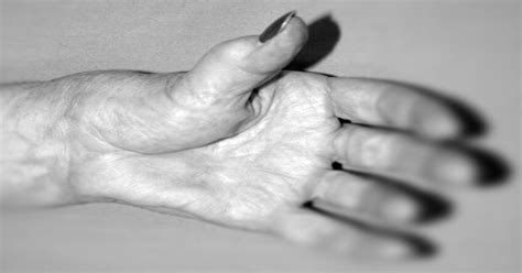 Thumb Pain Kayvon Izadi Md Hand Wrist Elbow Orthopedic Surgeon