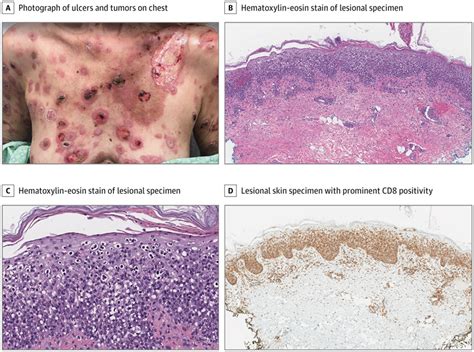 Rapidly Evolving Necrotic Plaques And Nodules In A Middle Aged Woman