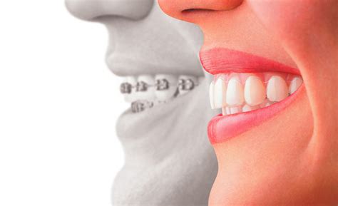 Tipos de ortodoncias invisibles Invisalign Clínica Larrañaga