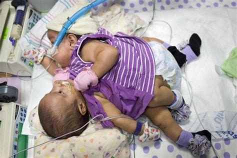 Rare Conjoined Twins Born Asiaone