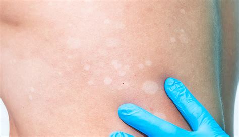 White Spots On Skin Causes And How To Get Rid Of Them