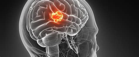 Understanding Glioblastoma The Most Common Type Of Malignant Brain Tumor