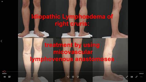 Lymphovenous Anastomosis For Lymphoedema Treatment Youtube