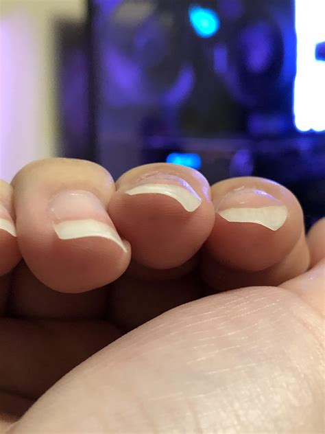 How Do I Prevent My Nails From Curling Like This Only These Two Nails