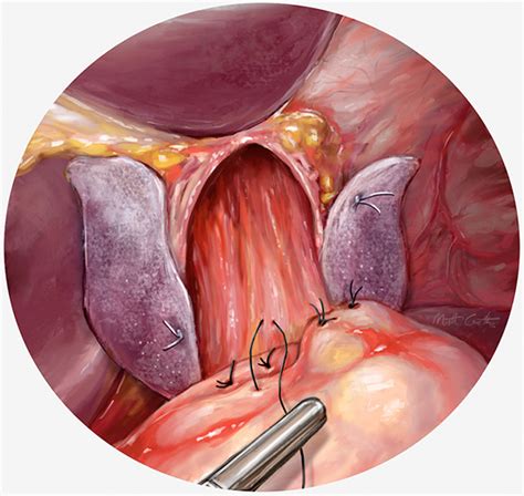Detail Of Gastric Hernia Procedure Illustration Series Matt Crotts