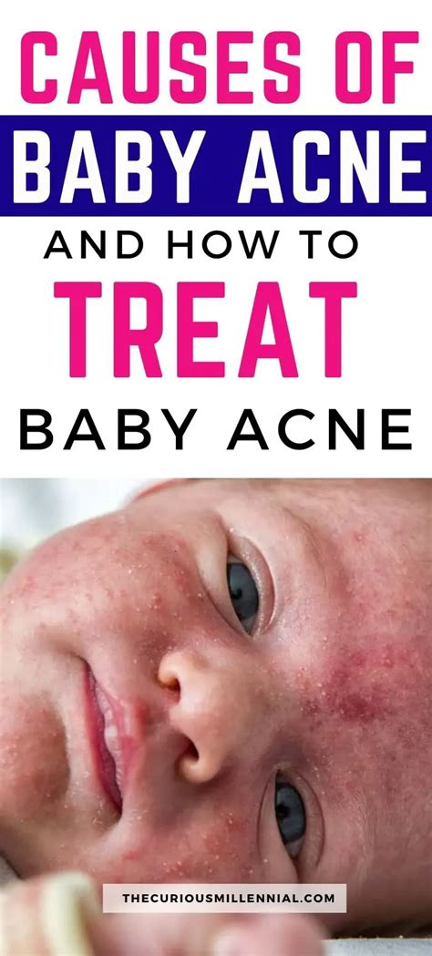Baby Acne Causes Symptoms And Treatment The Curious Millennial