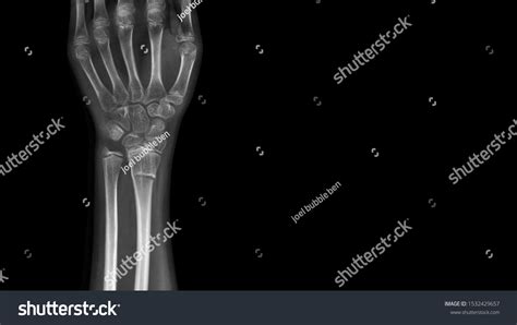 Film X Ray Wrist Radiograph Show Stock Photo 1532429657 Shutterstock