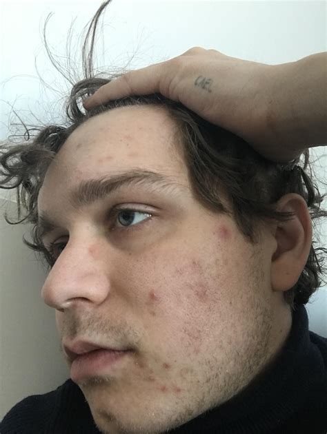 How Bad Is My Acne And Scarring How Can I Fix It Acne