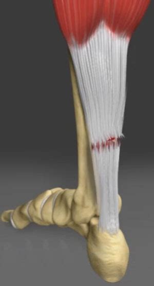 What is a tendon injury? Achilles Tendon Problems Penrith | Achilles Tendon Rupture ...