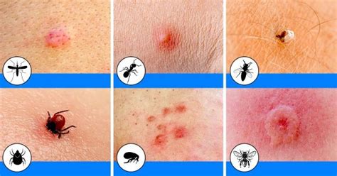 Insect Bites And Children Dr Joann Child Specialist