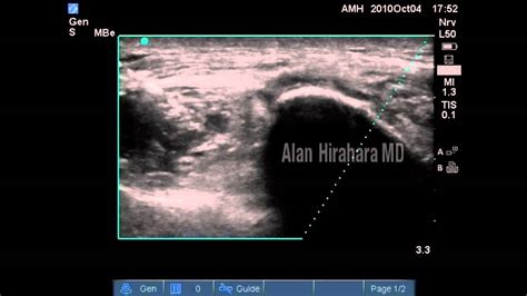 Ultrasound Guided Injection Sacroiliac Joint PRP YouTube