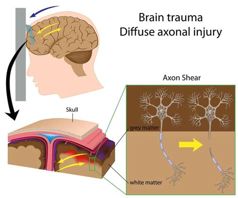 Diffuse Axonal Brain Injury Causes Symptoms Treatment