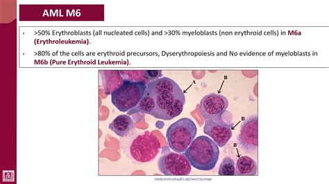 Hematology 2 U2 L29 FAB Classification Of AML Subtypes 8 YouTube