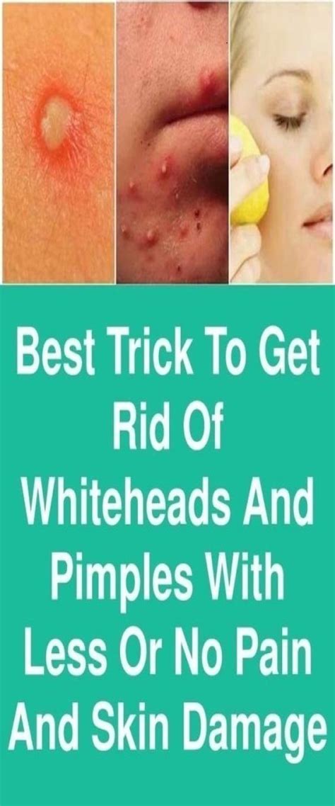 Remove Under The Skin Pimples Without Damaging Your Skin Pimples