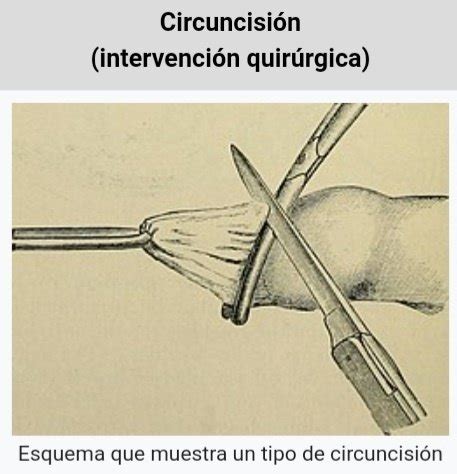 Cuáles son los tipos de circuncisión que hay Quora