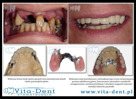 Protezy Bezklamrowe Vita Dent Stomatologia