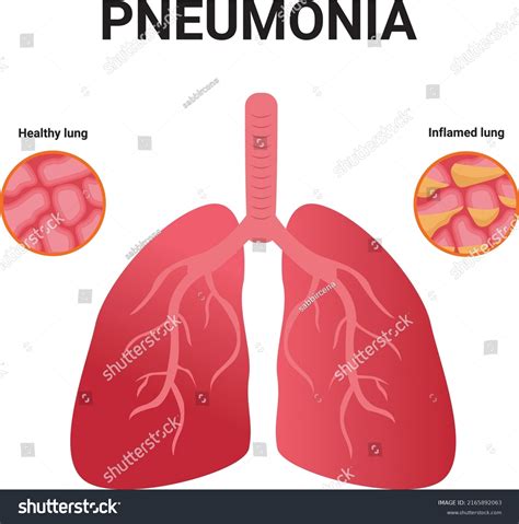 Pneumonia Normal Infected Alveoli Healthy Illness Stock Vector Royalty Free 2165892063