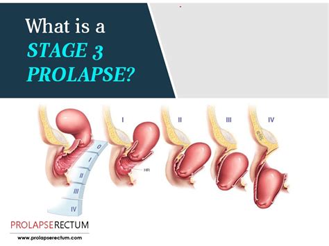 What Is A Stage 3 Prolapse In 2020 Rectal Prolapse Rectal Herbal