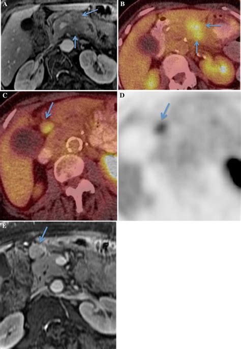 The Role Of 18f Fdg Petct And Petmri In Pancreatic Ductal