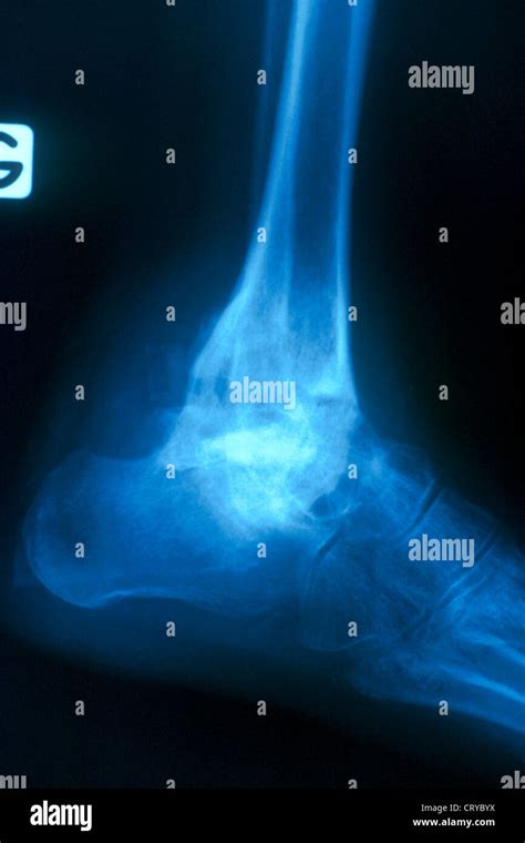 Arthritis Bone X Ray Stock Photo Alamy