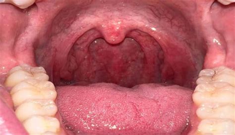 Cobblestone Throat What You Need To Know Any Health News