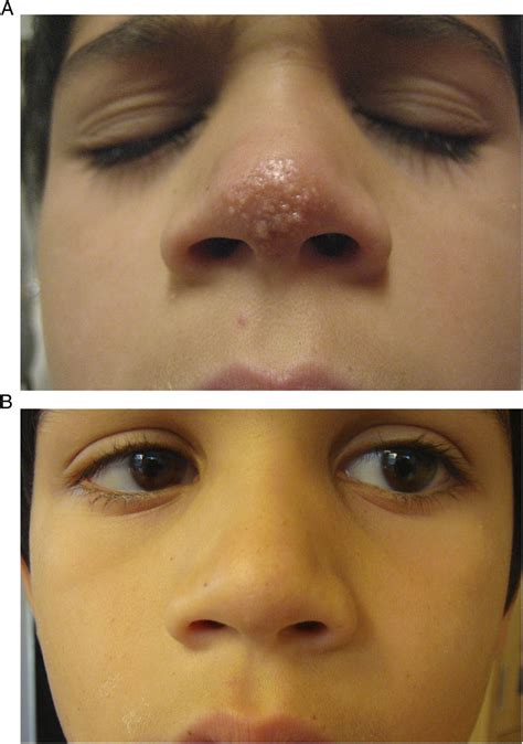 Milia En Plaque Of The Nose Report Of A Case And Successful Treatment