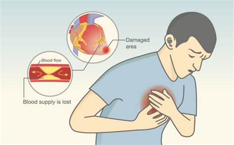 10 Poor Blood Circulation Symptoms That Require Immediate Attention