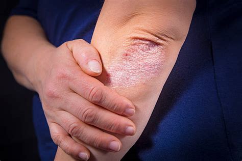 Psoriasis Skin Stock Photos Pictures And Royalty Free Images Istock