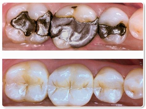 White Fillings Azure Dental Practice