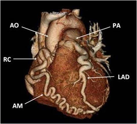 A Rare Case Of Anomalous Origin Of The Left Main Coronary Artery In An