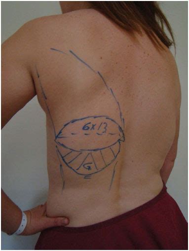 Rbcp Use Of The Myocutaneous Latissimus Dorsi Flap With Fat Extension