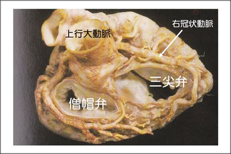 脑梗塞 癫痫 面瘫 三叉神经痛 老年痴呆 脑血栓形成 帕金森病 脑供血不足 失眠 面肌抽搐 重症肌无力. 僧帽弁閉鎖不全症（逆流）-2 | 心臓弁膜症 手術 | みどり病院 ...